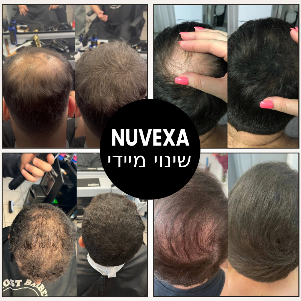 אבקת Nuvexa – מספר 1 בהסתרת קרחות